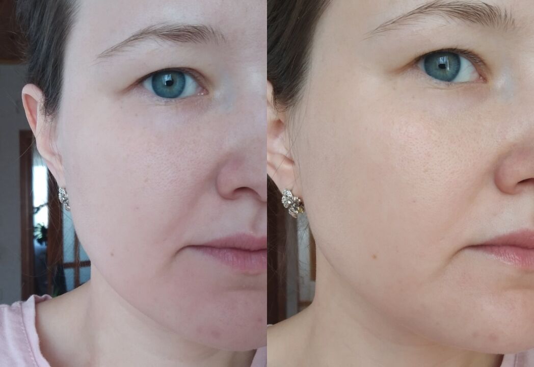 قبل وبعد استخدام كريم إينو جيالورون